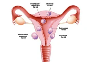 Uterine Fibroids