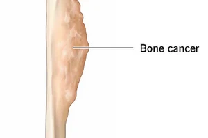Bone Tumors