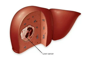 Liver Cancer